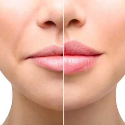 Lip augmentation