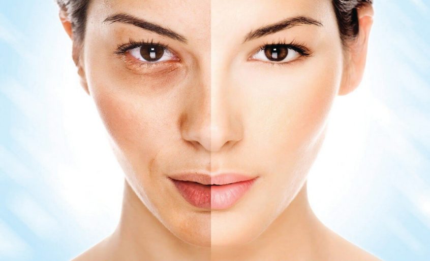 Melasma treatment in rawalpindi dr attiya skin matters