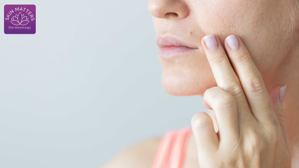 How to Get Rid of Large Open Pores Permanently