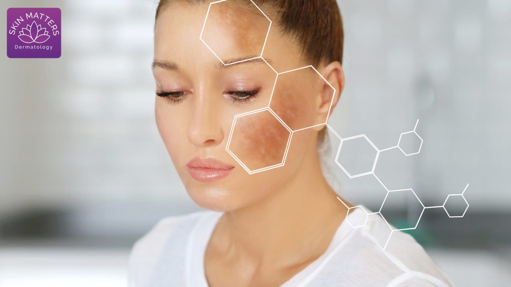 How to Cure Melasma from the Inside Naturally