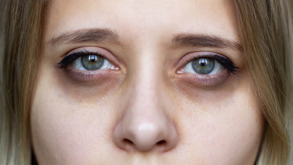 Dark Circles