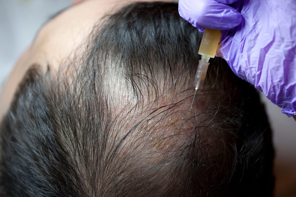PRP for Hair Loss