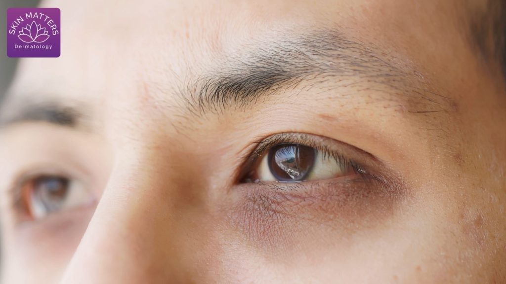 Laser Treatments for Dark Circles