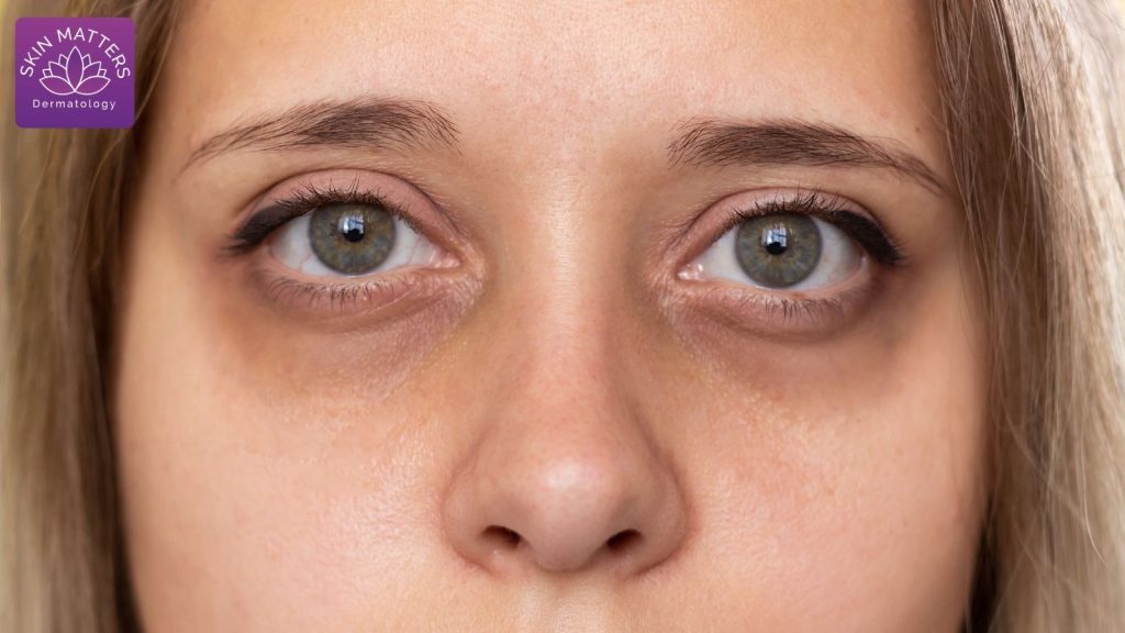 PRP and Fillers Can Reduce Dark Circles Effectively