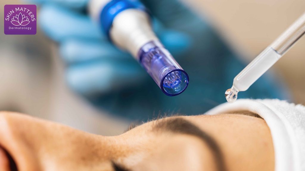 PRP with Microneedling